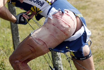 FOTOGALERIA: La pierna de Hoogerland se lleva la peor parte