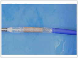 Cambio de válvula pulmonar sin cirugía a corazón abierto