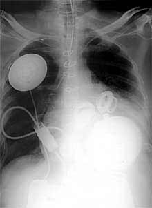 El corazón artificial, por rayos X.