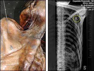 Fotografía y radiografía (en el círculo, la punta de la flecha que le mató ) del    hombre de los hielos. 