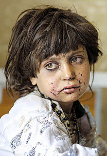 Una niña con heridas de metralla en la cara, en un hospital de Quetta.