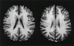 Imágenes de un cerebro de hombre (a la izquierda) y otro de mujer.