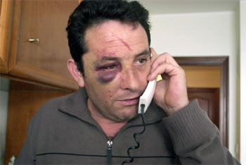 Antonio Morales, tras ser agredido por un juvenil y sus familiares  hace unos días.