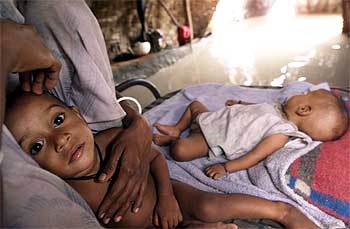 Dos niños indios severamente malnutridos en Nueva Delhi (India).