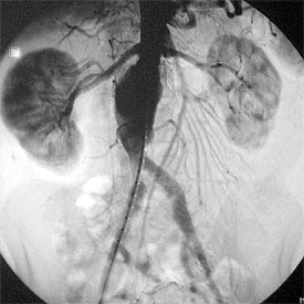 Arteriografía anterior a la intervención que revela el gran tamaño y la proximidad del aneurisma a los riñones.