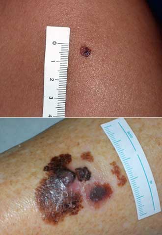 Arriba, melanoma incipiente, y abajo, un gran melanoma.