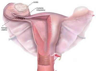 Esquema de la ubicación del dispositivo de esterilización en la trompa de Falopio.