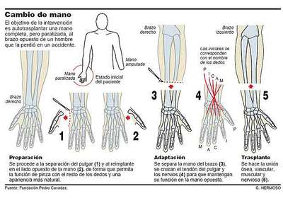 Autotrasplante de mano