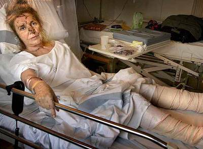 Júlia Vilaró, ayer en su habitación del hospital de Vall d'Hebron donde espera para ser intervenida de las fracturas en un pie.