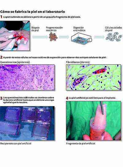 Piel cultivada para grandes quemados