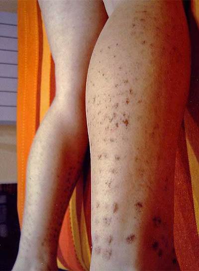 Quemaduras sufridas por la víctima.