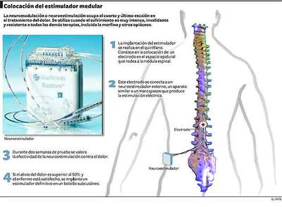 Electrodos para el dolor intratable