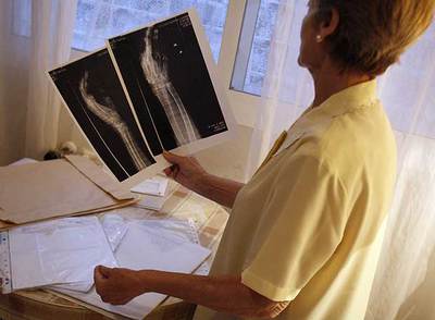 Carmen muestra unas radiografías de su lesión en la mano, que ocurrió por falta de rehabilitación.