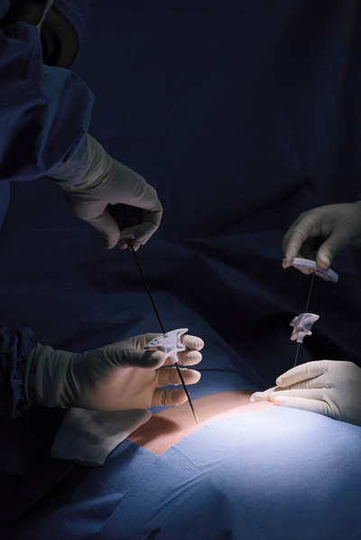 La extracción de médula debe hacerse en un quirófano.