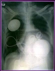   El primer enfermo con corazón artificial sorprende por su rápida recuperación   En la imagen, radiografía del tórax del paciente con su nuevo corazón. (REUTERS)
