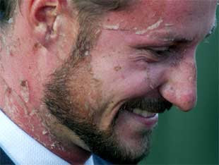 Haakon y Mette-Marit se recuperan de las quemaduras sufridas durante una entrevista