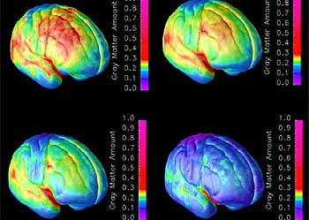 El raciocinio termina de desarrollarse en los primeros años de la edad adulta, según los autores del estudio. En las fotos, el progreso de maduración del cerebro.
